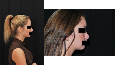 Rhinoplasty before and after photo