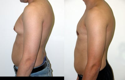 Breast Reduction before and after photo