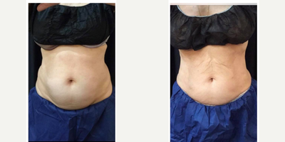 CoolSculpting before and after photo