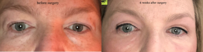 Double Eyelid Surgery before and after photo