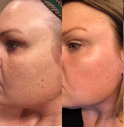 IPL before and after photo