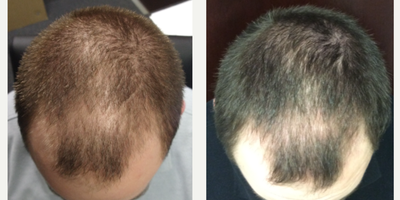 PRP Injections before and after photo