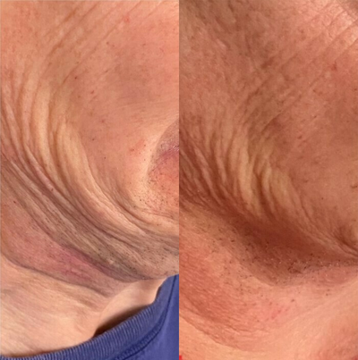 Botox before and after photo