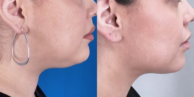 Chin Liposuction before and after photo