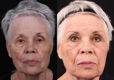 CO2 Laser before and after photo