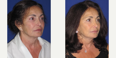 before and after image