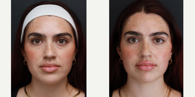 Juvederm before and after photo