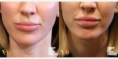 Lip Fillers before and after photo