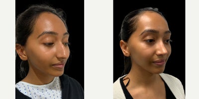 Rhinoplasty before and after photo
