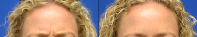 Botox before and after photo