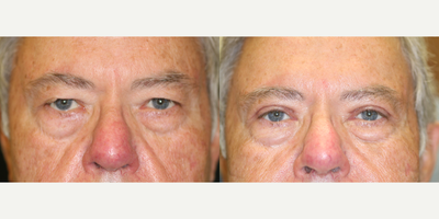 Eyelid Surgery before and after photo
