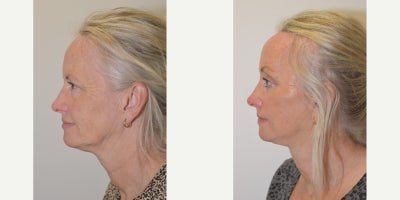 Eyelid Surgery before and after photo
