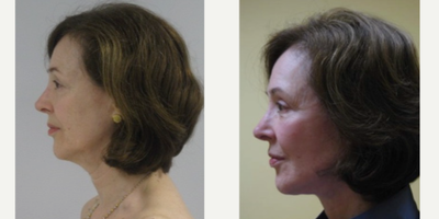 Lower Facelift before and after photo