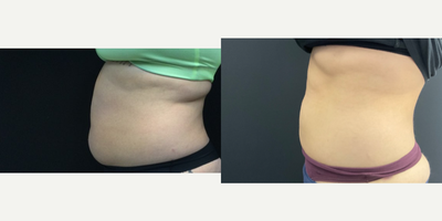 BodyTite before and after photo