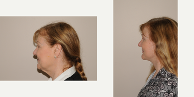 Facelift before and after photo