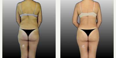 Liposuction before and after photo