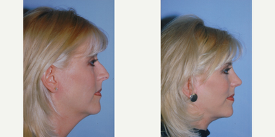Neck Lift before and after photo