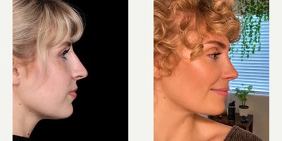 Rhinoplasty before and after photo