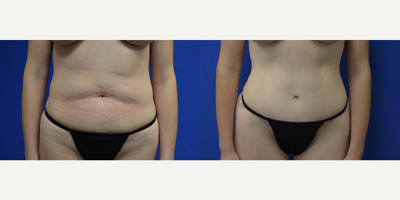 Tummy Tuck before and after photo