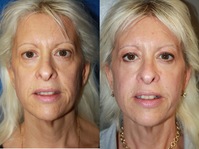 Facial Fat Transfer before and after photo