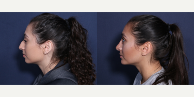 Rhinoplasty before and after photo