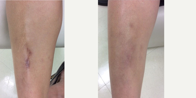 Fraxel Laser before and after photo