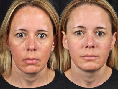 Sculptra before and after photo