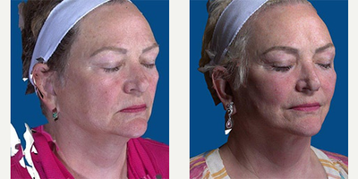 Brow Lift before and after photo