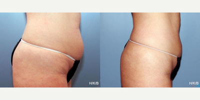 CoolSculpting before and after photo