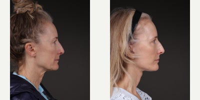Deep Plane Facelift before and after photo