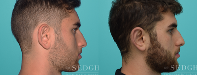 Ear Surgery before and after photo