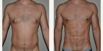 Gynecomastia Surgery before and after photo