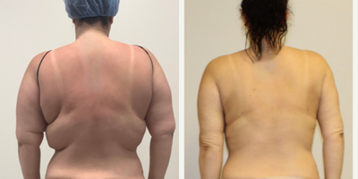 Laser Liposuction before and after photo