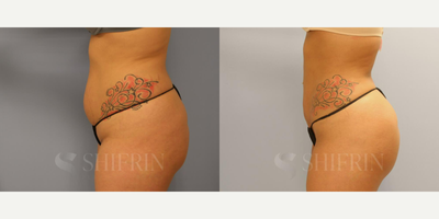 Liposuction before and after photo