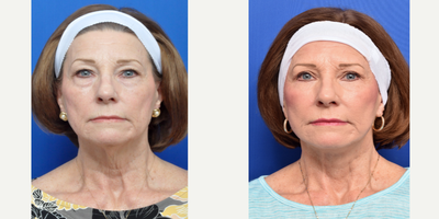 Neck Lift before and after photo