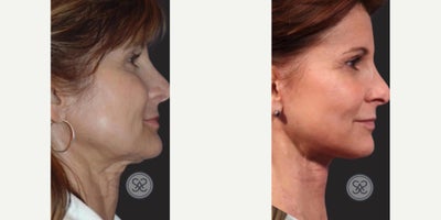 Neck Lift before and after photo