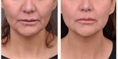Profound RF before and after photo