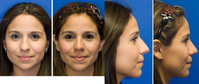 Rhinoplasty before and after photo