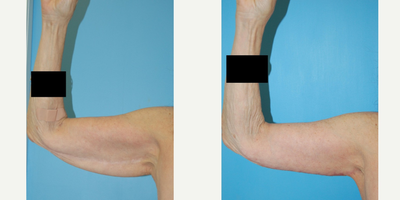 Arm Lift before and after photo