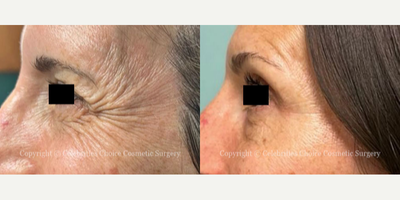 Botox before and after photo