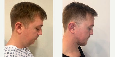 Chin Implant before and after photo