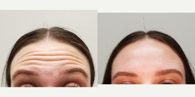 Dysport before and after photo