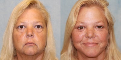 Facelift before and after photo
