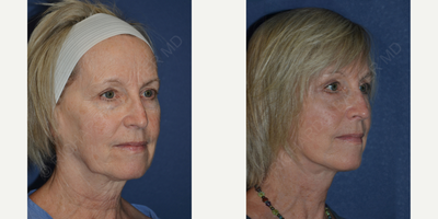 Facelift before and after photo