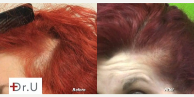 Hair Loss Treatment before and after photo