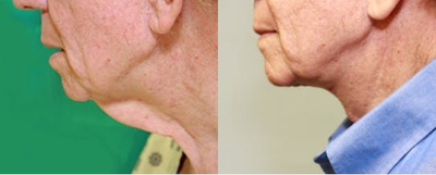 Neck Lift before and after photo