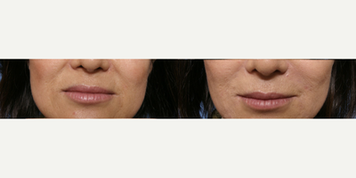 Voluma before and after photo