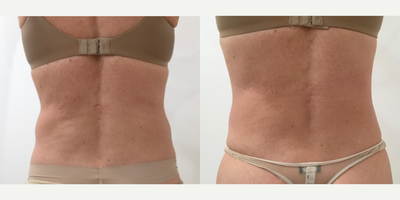 Emsculpt before and after photo