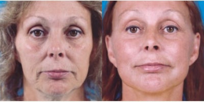 Facelift before and after photo