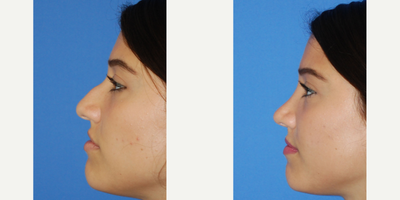 Rhinoplasty before and after photo